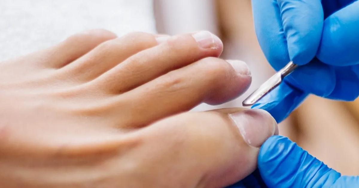 remédio para unha encravada