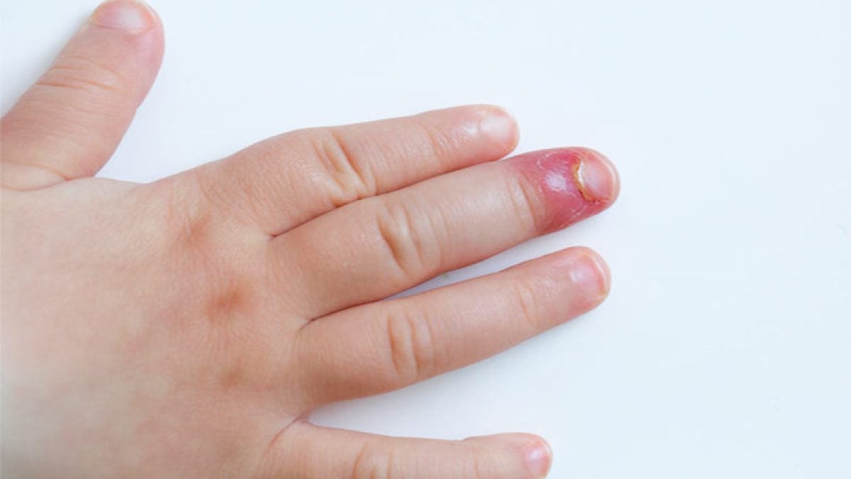 5 ideias de títulos:
1. Unha Inflamada com Pus: Guia Completo de Tratamento e Cuidados
2. Paroníquia e Unheiro: Entenda as Causas e Como Tratar
3. Pomadas e Antibióticos: Medicamentos Essenciais para Infecções de Unha
4. Cuidados Caseiros e Médicos para Unha com Pus: O Que Fazer?
5. Quando Procurar um Médico para sua Unha Inflamada?