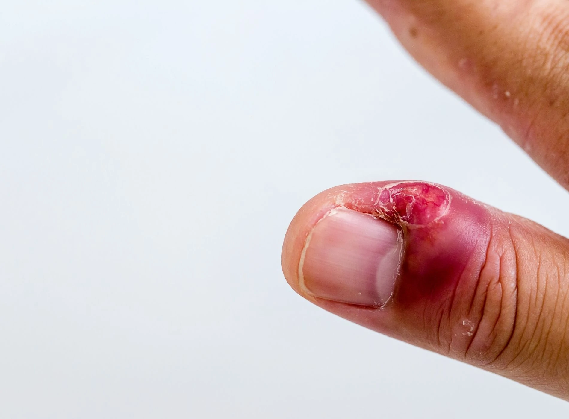 5 ideias de títulos:
1. Unha Inflamada com Pus: Guia Completo de Tratamento e Cuidados
2. Paroníquia e Unheiro: Entenda as Causas e Como Tratar
3. Pomadas e Antibióticos: Medicamentos Essenciais para Infecções de Unha
4. Cuidados Caseiros e Médicos para Unha com Pus: O Que Fazer?
5. Quando Procurar um Médico para sua Unha Inflamada?