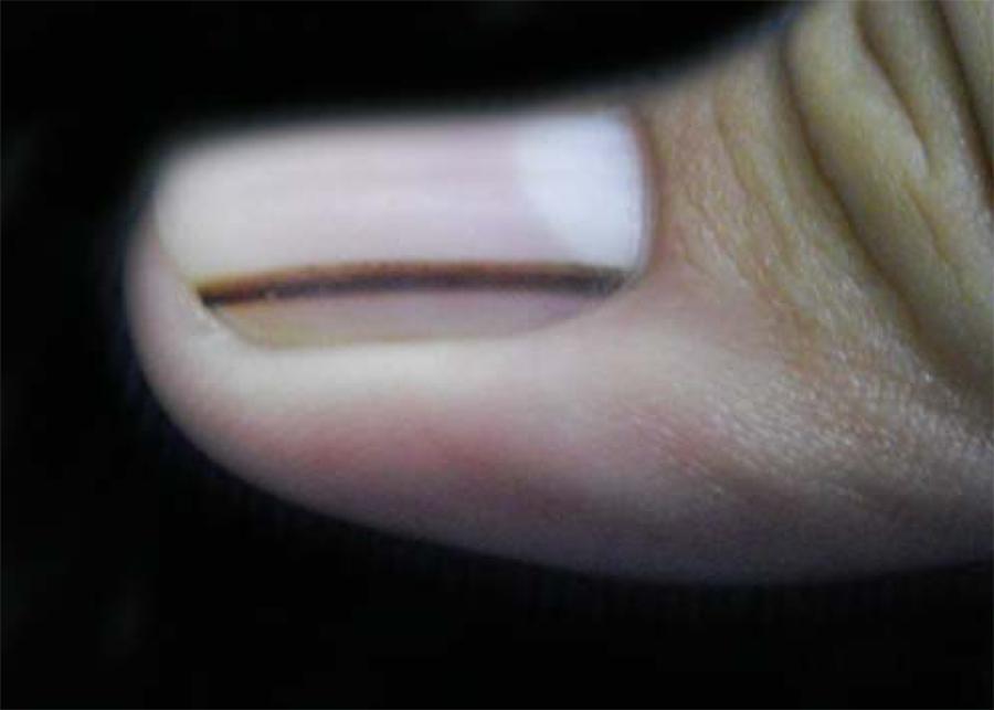 Melanoníquia Estriada: Entenda o Risco Preto na Unha e Quando se Preocupar; Risco Preto na Unha: Causas