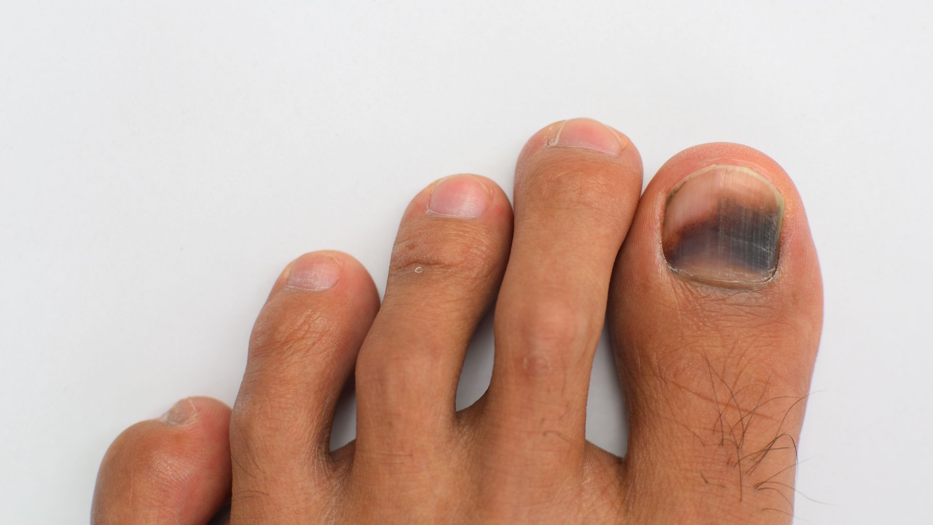 Sinais de Alerta e Diagnóstico Precoce; Melanoma Ungueal: O Que Você Precisa Saber Sobre o Câncer de Unha; Mancha Escura na Unha: Diferenciando Causas Benignas de Melanoma; Guia Completo: Como Identificar e Tratar Problemas de Pigmentação na Unha