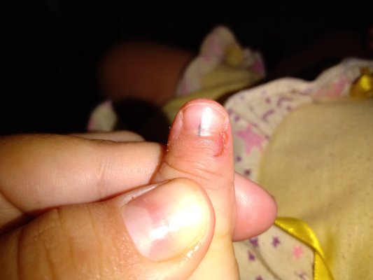 Sinais de Alerta e Diagnóstico Precoce; Melanoma Ungueal: O Que Você Precisa Saber Sobre o Câncer de Unha; Mancha Escura na Unha: Diferenciando Causas Benignas de Melanoma; Guia Completo: Como Identificar e Tratar Problemas de Pigmentação na Unha