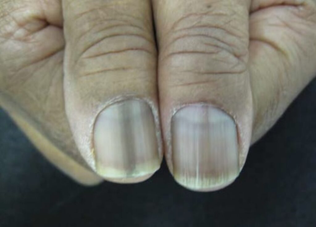 unha preta após pancada