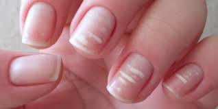 mancha escura na unha