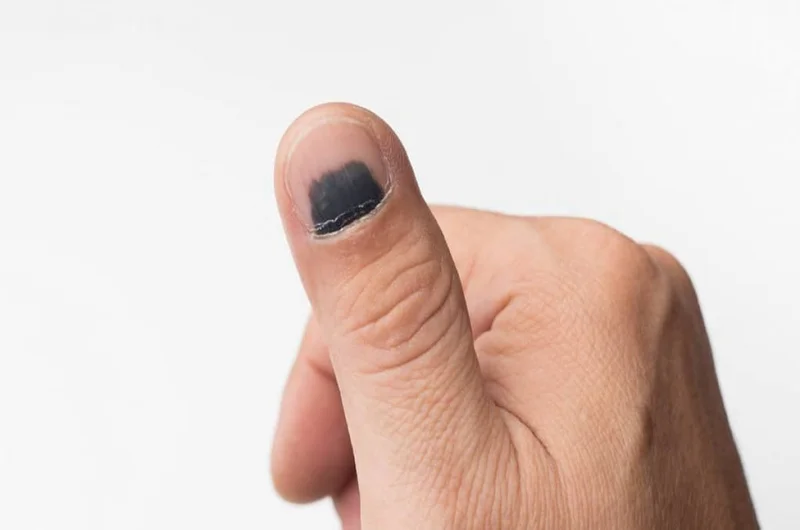risquinho preto na unha é câncer?
