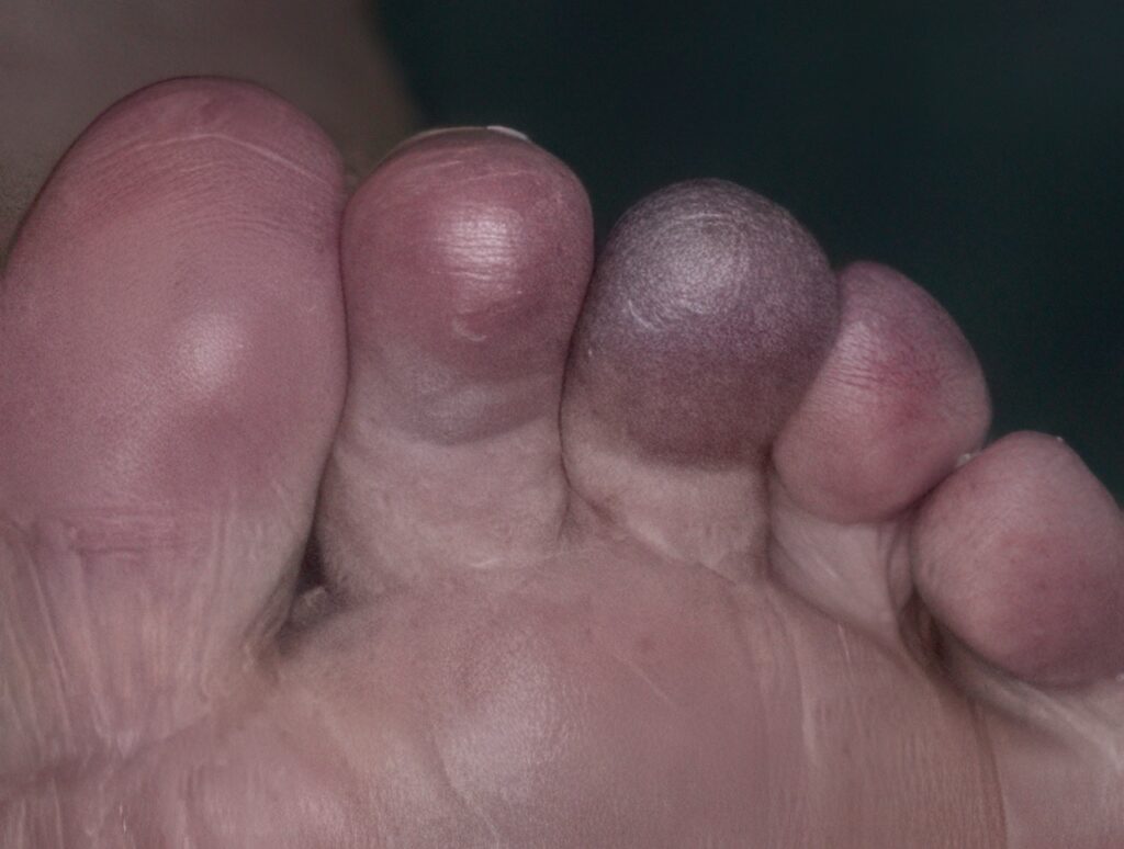 O que fazer imediatamente após machucar a unha do dedão