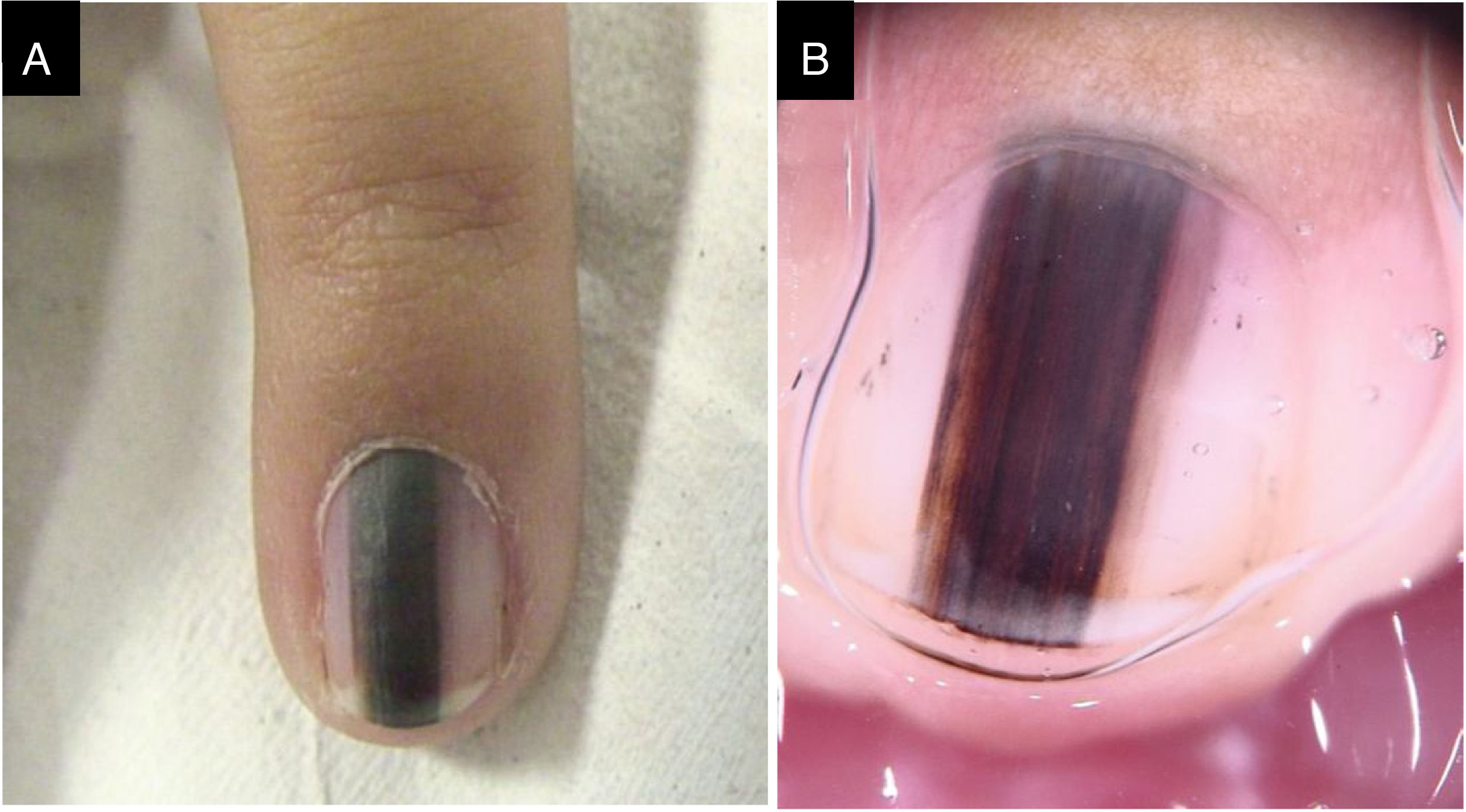 melanoma subungueal