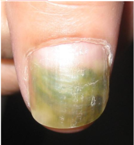 unha verde bacteriana