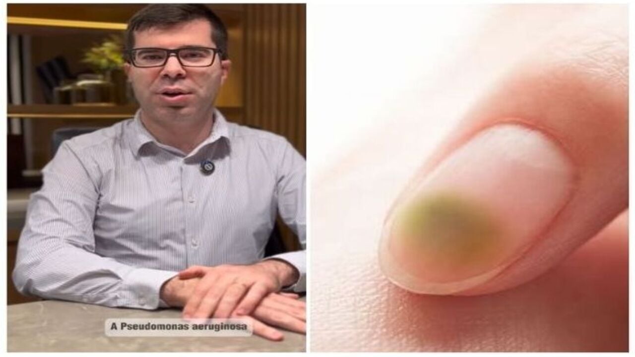 infecção por Pseudomonas nas unhas