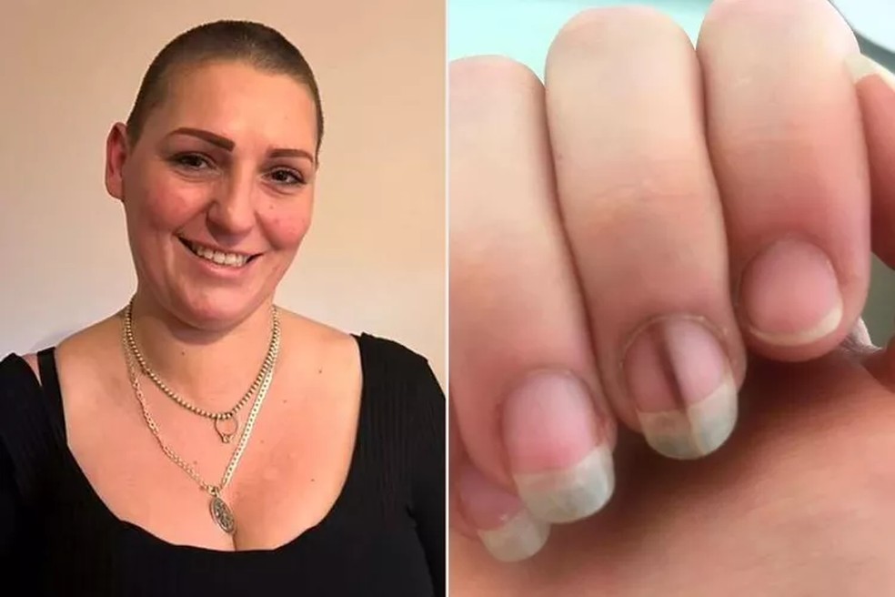 Fatores de Risco e Localizações Mais Comuns do Melanoma Ungueal