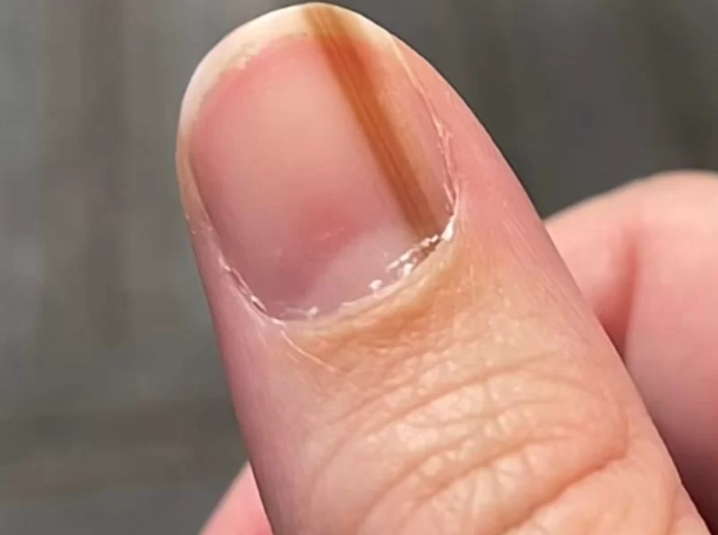 A Diferença Crucial: Câncer de Unha vs. Micose