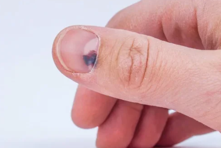 O Que Fazer ao Notar uma Faixa Escura na Unha?