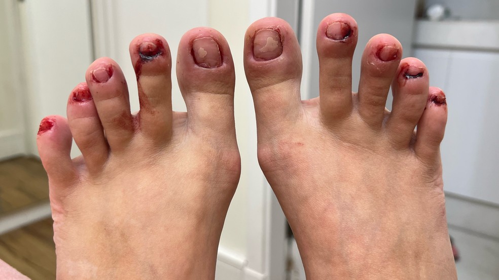 sonhar arrancando a unha do dedão do pé