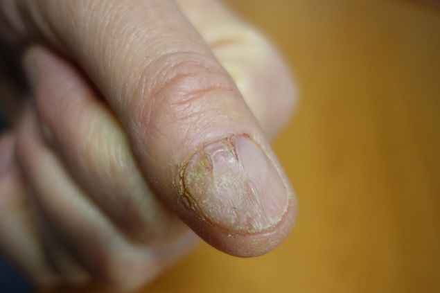 O Que Significa Sonhar com Unha Caindo? Guia Completo de Interpretações; Sonhei que Minha Unha Estava Caindo: Desvende os Sinais do Subconsciente; Unha do Pé ou da Mão Caindo no Sonho: Entenda as Diferenças de Significado; Ansiedade e Estresse: Como o Sonho com Unhas Caindo Reflete Sua Saúde Emocional; Sonhar com Unha Caindo: É um Alerta de Mudança ou Perda?