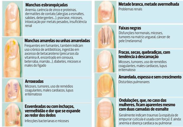 tipos de micose de unha