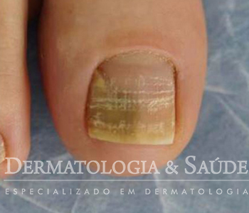 Prevenção da micose de unha: dicas para manter suas unhas saudáveis