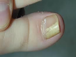 fungos nas unhas do pé