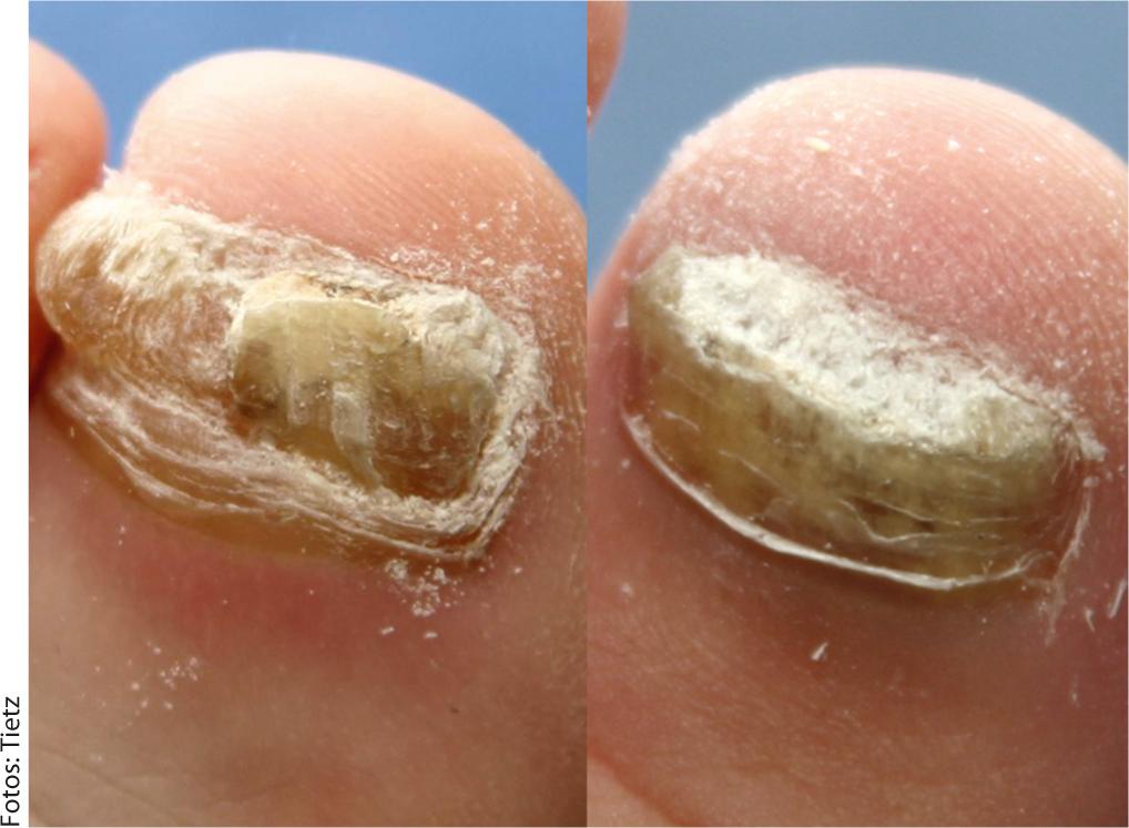 micose unha distal lateral