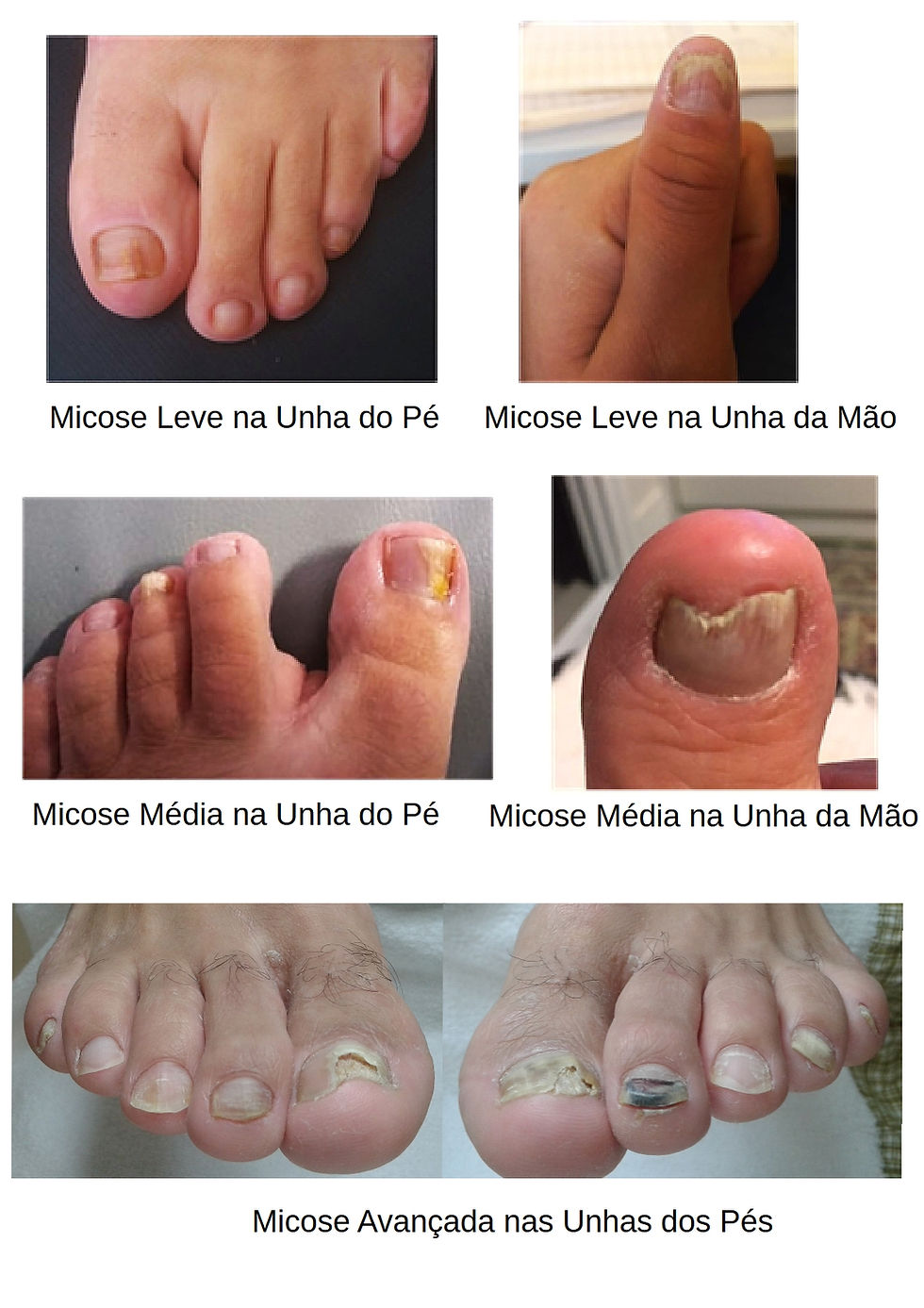micose unha superficial branca