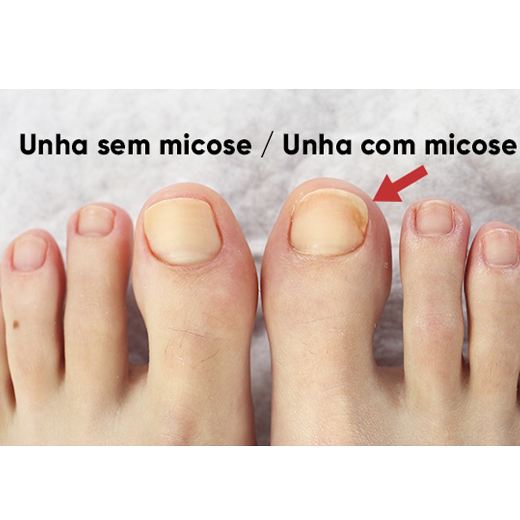 tratamento micose unha pés