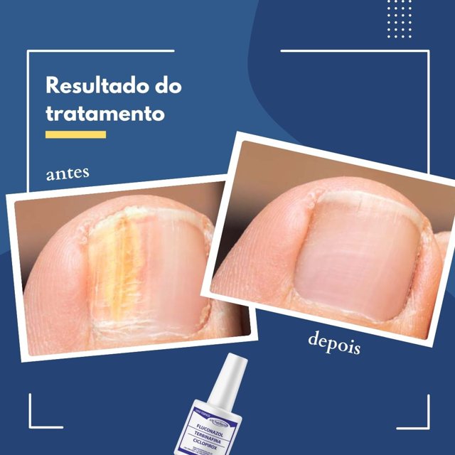 tratamento micose unha rápido