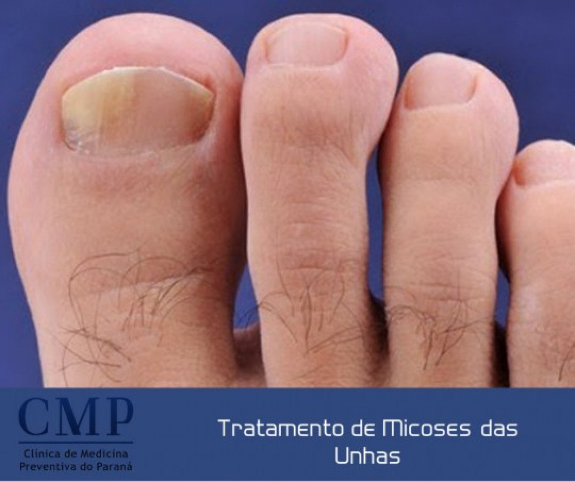 tratamento micose unha esmalte