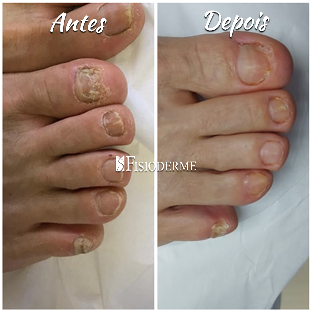 tratamento micose unha esmalte