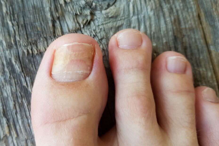 tratamento micose unha laser