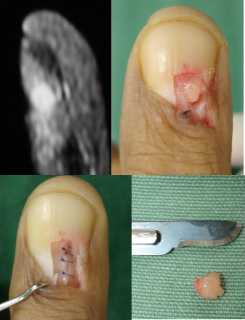 1. O que é o Tumor Glômico e seus Sintomas?
2. Como é feito o Diagnóstico do Tumor Glômico?
3. Opções de Tratamento para o Tumor Glômico
4. Tumor Glômico: Quando Procurar um Especialista?
5. Prevenção e Cuidados com Tumores Glômicos