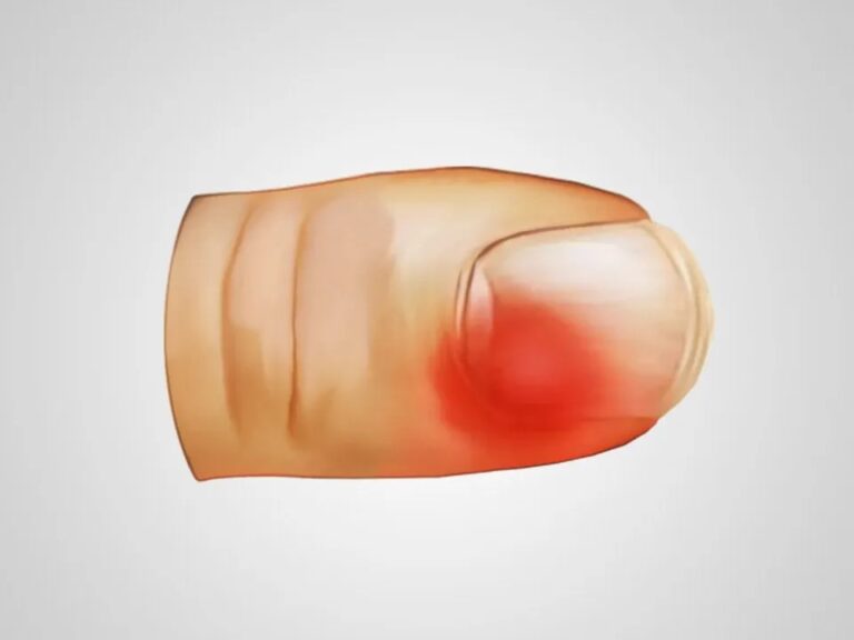 1. O que é o Tumor Glômico e seus Sintomas?
2. Como é feito o Diagnóstico do Tumor Glômico?
3. Opções de Tratamento para o Tumor Glômico
4. Tumor Glômico: Quando Procurar um Especialista?
5. Prevenção e Cuidados com Tumores Glômicos