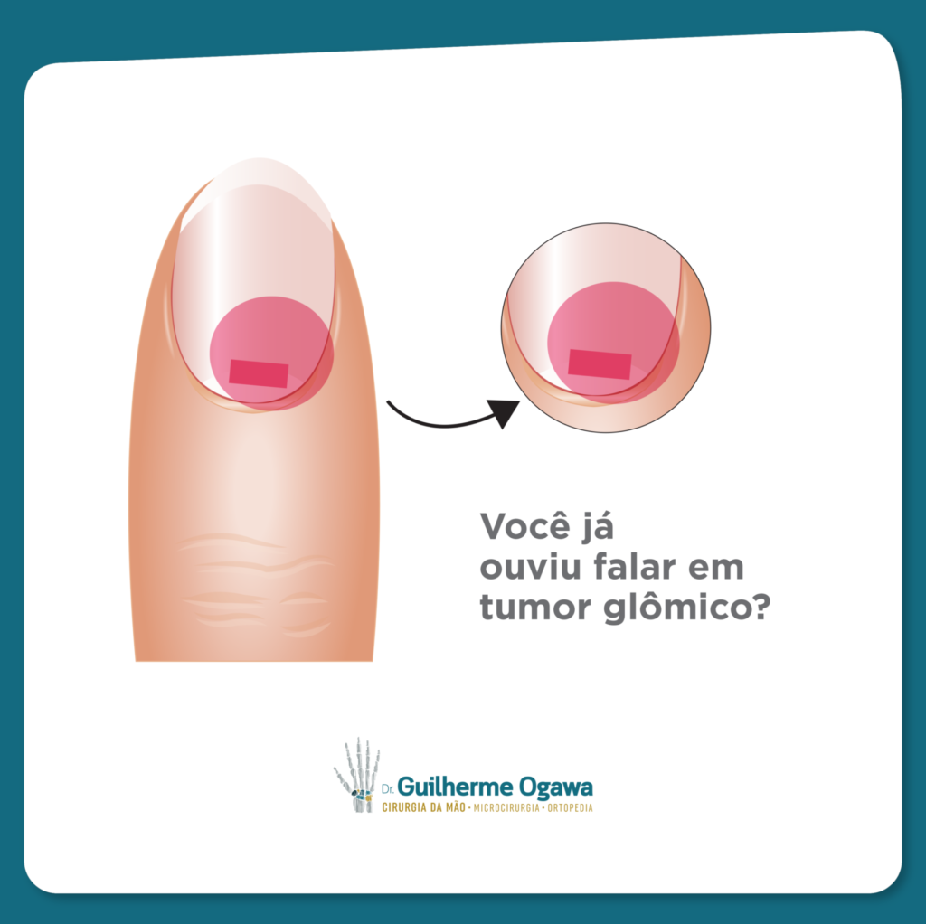 tumor glomico unha