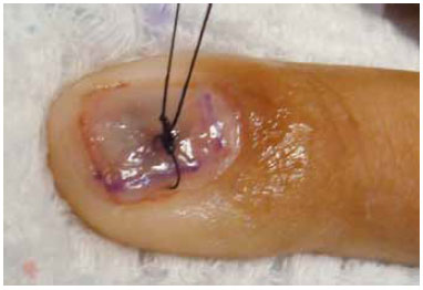 1. O que é o Tumor Glômico e seus Sintomas?
2. Como é feito o Diagnóstico do Tumor Glômico?
3. Opções de Tratamento para o Tumor Glômico
4. Tumor Glômico: Quando Procurar um Especialista?
5. Prevenção e Cuidados com Tumores Glômicos