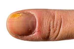 Quando o Amarelamento das Unhas é um Sinal de Alerta para a Saúde?