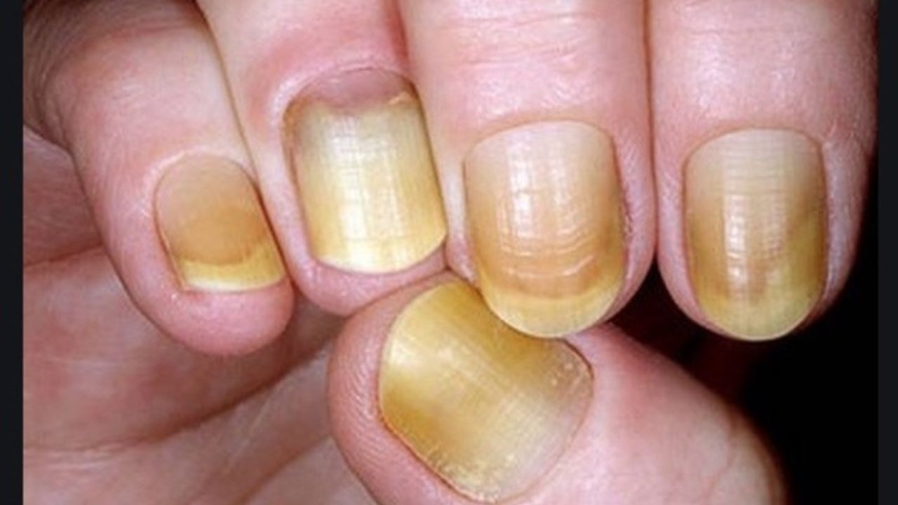 Receitas Caseiras para Unhas Amareladas: Mitos e Verdades