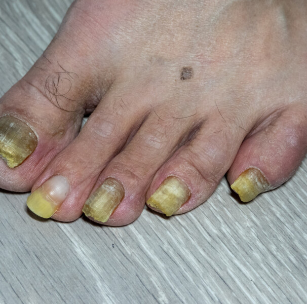 unha amarelada