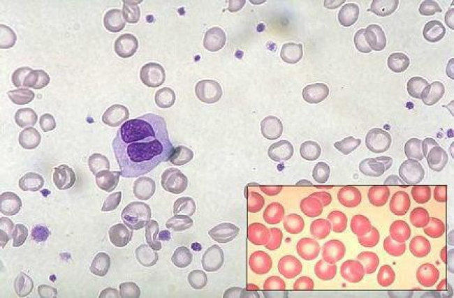 5 ideias de títulos:
1. Anemia Ferropriva: Como a Falta de Ferro Afeta Suas Unhas
2. Unhas Quebradiças? Pode Ser Sinal de Deficiência de Ferro!
3. Os Sinais nas Unhas que Indicam Anemia e Como Tratar
4. Além das Unhas: Outros Sintomas da Anemia por Deficiência de Ferro
5. Diagnóstico e Tratamento da Anemia Ferropriva: O Que Você Precisa Saber
