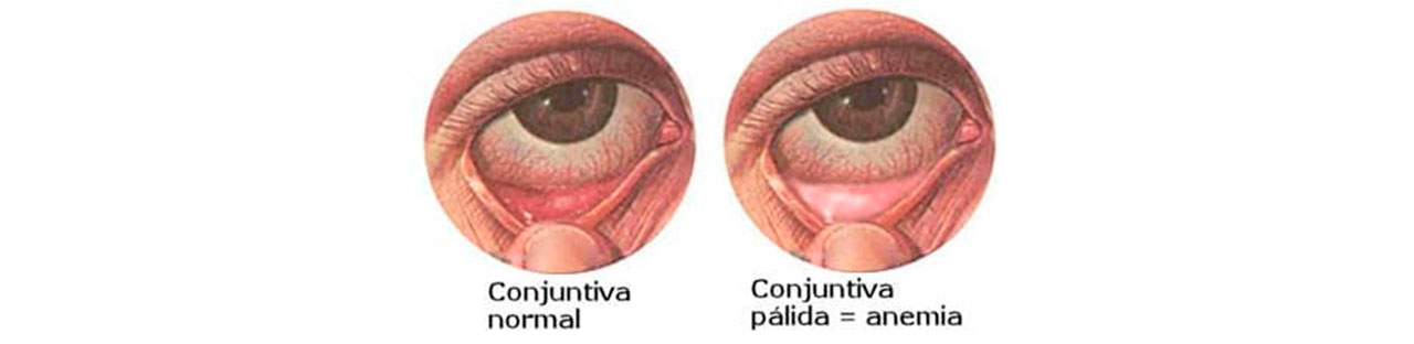 5 ideias de títulos:
1. Anemia Ferropriva: Como a Falta de Ferro Afeta Suas Unhas
2. Unhas Quebradiças? Pode Ser Sinal de Deficiência de Ferro!
3. Os Sinais nas Unhas que Indicam Anemia e Como Tratar
4. Além das Unhas: Outros Sintomas da Anemia por Deficiência de Ferro
5. Diagnóstico e Tratamento da Anemia Ferropriva: O Que Você Precisa Saber