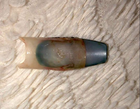 como fazer a unha arrancada nascer mais rápido