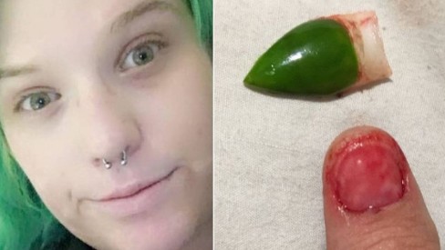 unha descolada por trauma