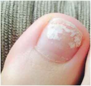 unha esbranquiçada depois de tirar esmalte