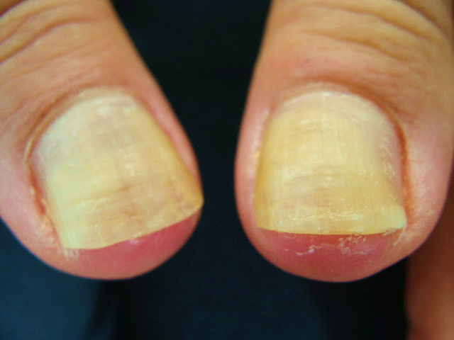 Tratamentos Inovadores para Onicomicose: Além dos Esmaltes Comuns