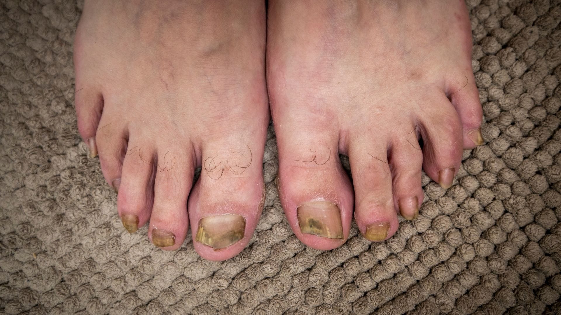 Sintomas e Tratamento Eficaz; 2. Unha Verde Após Unha de Gel? Saiba Como Prevenir e Tratar; 3. Diferença Crucial: Unha Verde (Bactéria) vs. Micose (Fungo); 4. Como Tratar a Unha Esverdeada em Casa com Antissépticos e Cuidados Simples; 5. Pseudomonas Aeruginosa na Unha: Guia Completo de Diagnóstico e Recuperação