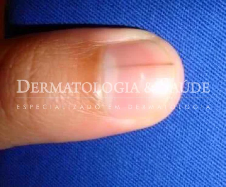 unhas com textura irregular