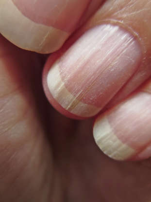 listras verticais nas unhas