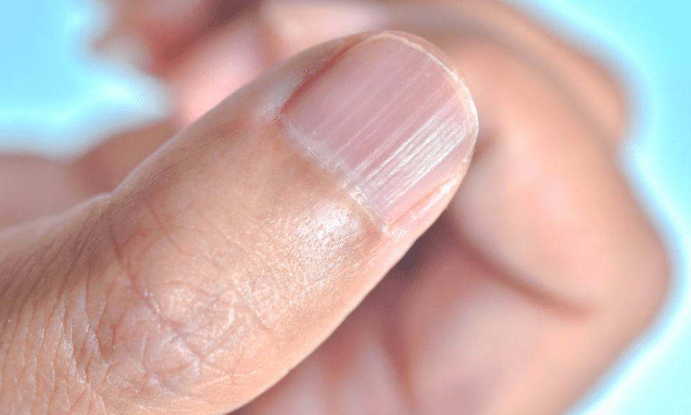 ondulações nas unhas