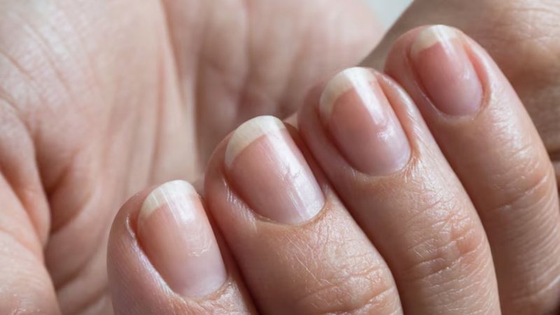 tratamento para unhas estriadas