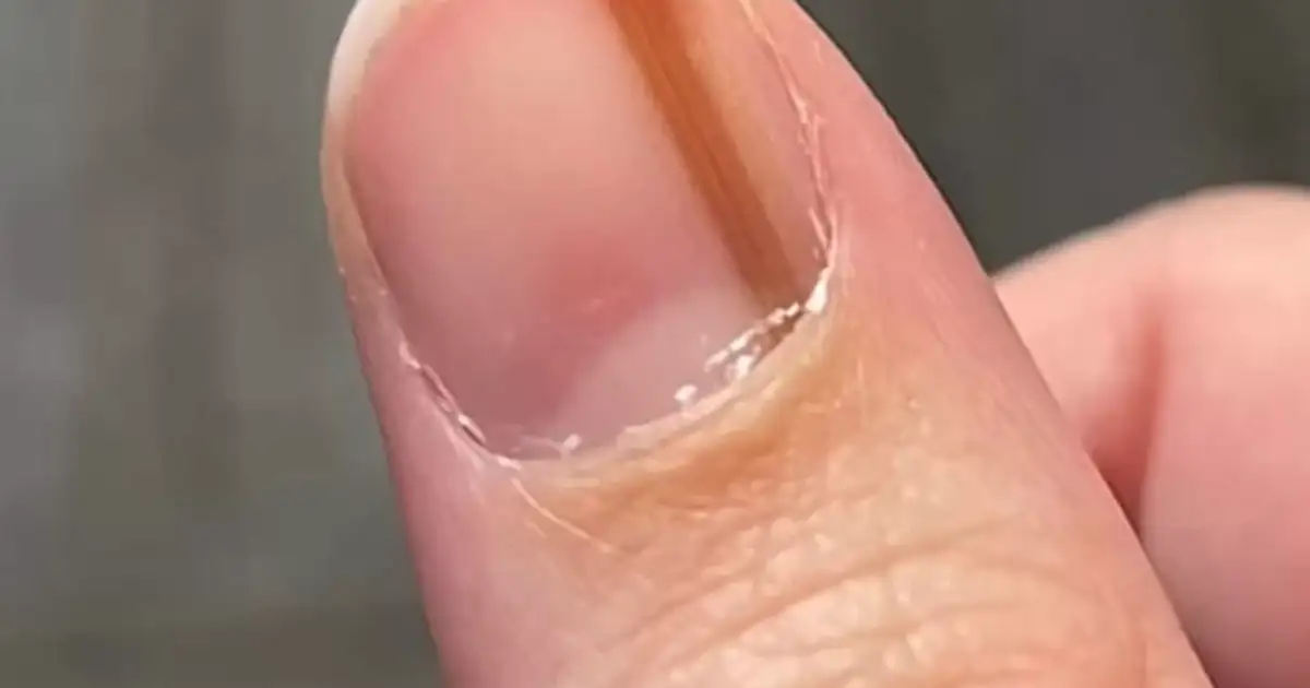 unha fraca e quebradiça