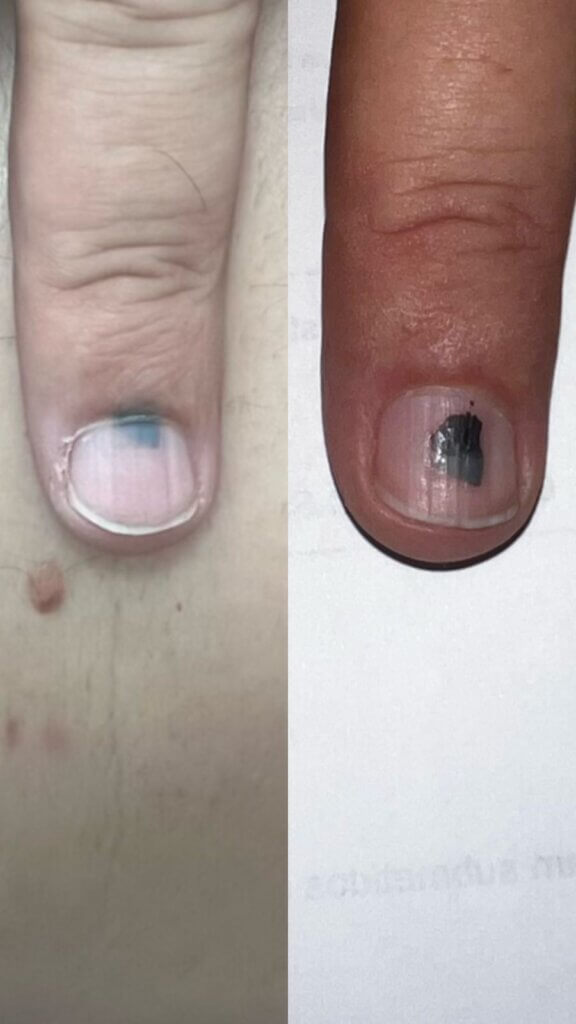 unha com sangramento interno