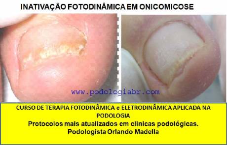 fungo na unha