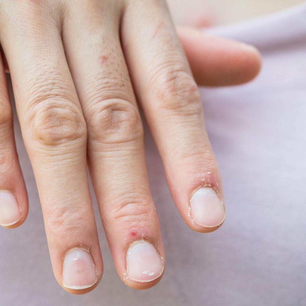 O papel dos antibióticos no tratamento de infecções ungueais